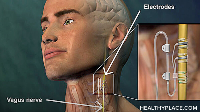 Vagus nerve stimulation is for treatment-resistant depression. Learn about VNS therapy, vagus nerve stimulation side effects and cost.