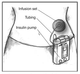 Insulin Pump