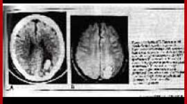 Neurologist John Friedberg how psychiatric drugs and electroshock damage the brain. He says all suffer some brain damage and memory loss.