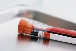 Recently a blood test was heralded for predicting increased suicide risk but can we really predict suicide risk with a simple blood test?